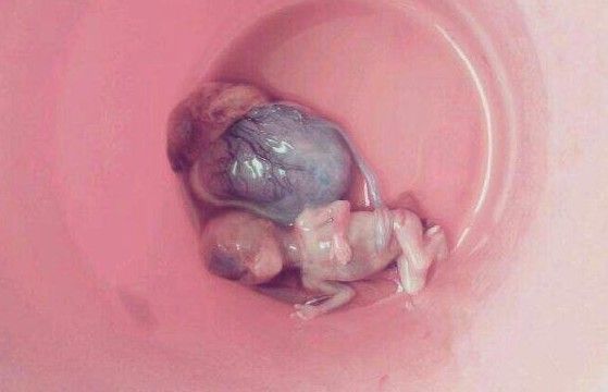 八个月堕胎图片图片