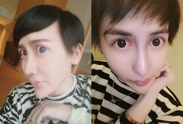 蛇精男打玻尿酸失败 哭喊:这样怎么出门见人!