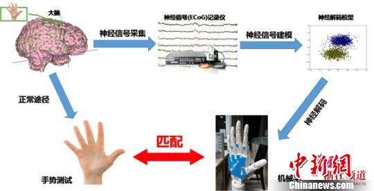 脑机接口示例图。　院方提供摄