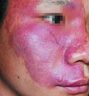 小心红胎记是祸不是福