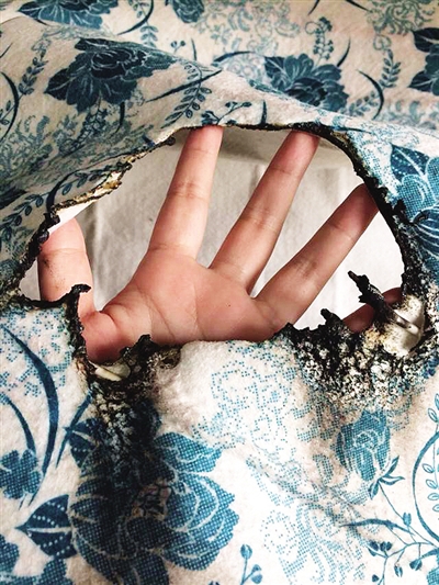 电褥子起火 老人身体近一半皮肤被烧焦/图