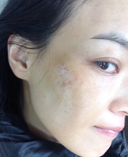 舒淇右脸大片黑青疑遭颜面重击图