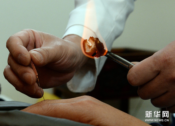 医院为什么不扎火针