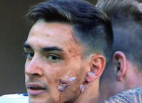 慎入米兰小鲜肉遭钢钉踩脸颜值担当恐毁容图