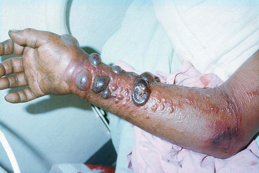 埃博拉病人惨状图片