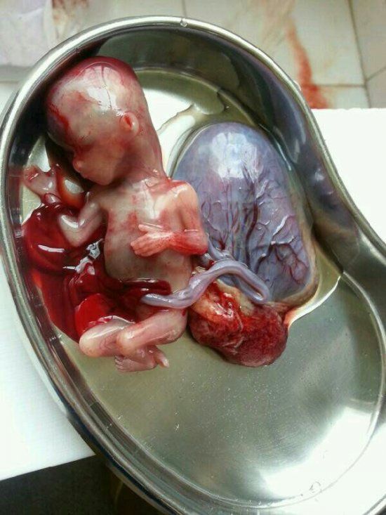 10周胎儿流产图片图片