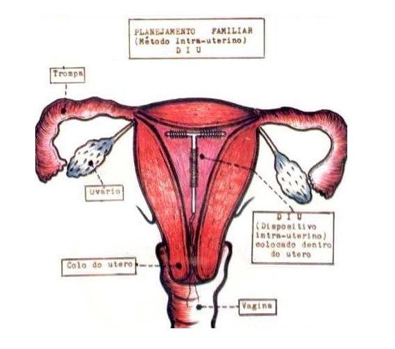 图解女性产后上环私密过程图