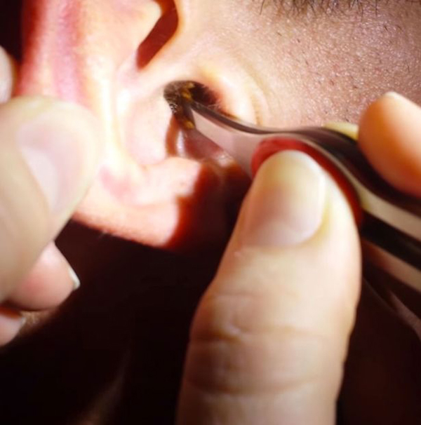 男子耳朵中的耳屎【环球网综合报道】虽然耳垢可以保护耳道,但过多的
