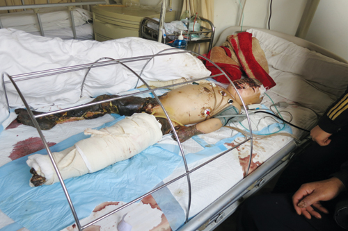 玩耍时引燃草垛4岁男孩重度烧伤