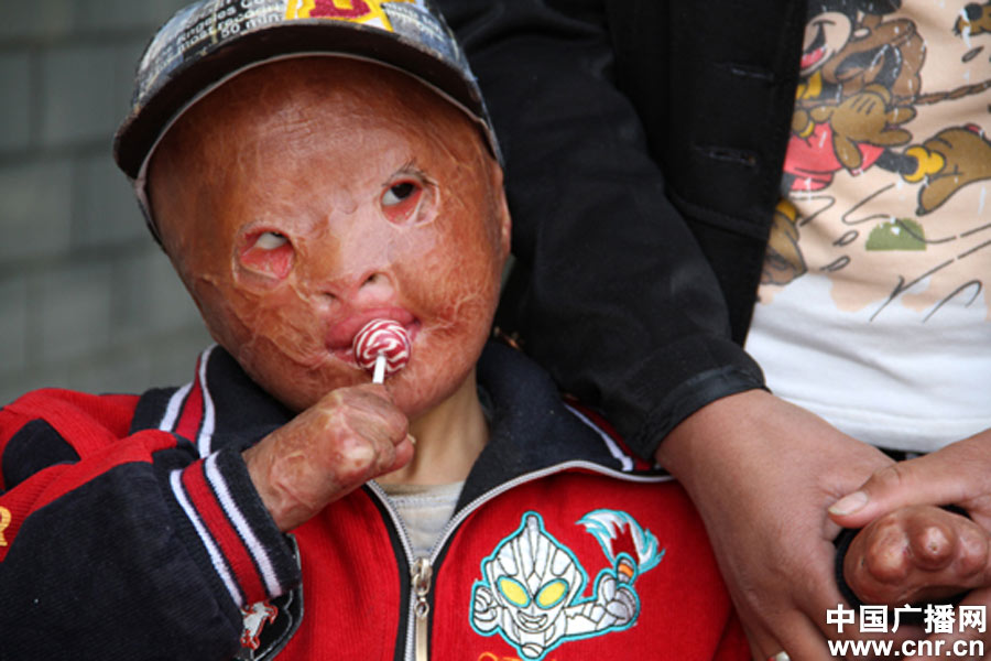 央广独家宁夏烧伤男孩受助赴北京整容